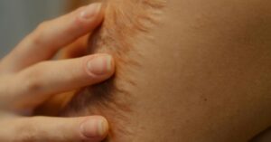 Burn Injury