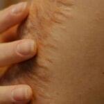 Burn Injury Compensation & Classification in Cambridge